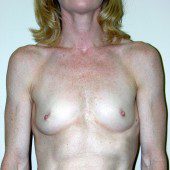 Breast Augmentation 30