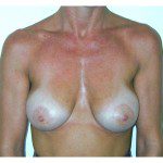 Breast Augmentation 16 After Photo - 2