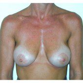 Breast Augmentation 16