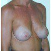 Breast Augmentation 16 After Photo Thumbnail