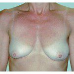 Breast Augmentation 16 Before Photo - 2