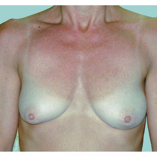 Breast Augmentation 16 Before Photo 