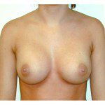 Breast Augmentation 17 After Photo - 1