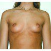 Breast Augmentation 17 Before Photo Thumbnail