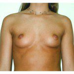 Breast Augmentation 17 Before Photo - 1