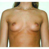 Breast Augmentation 17