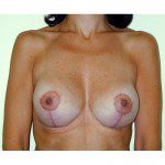 Breast Augmentation 18 After Photo - 9