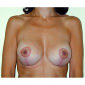 Breast Augmentation 18