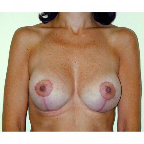 Breast Augmentation 18 After Photo 