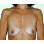 Breast Augmentation 18 Before Photo - 12