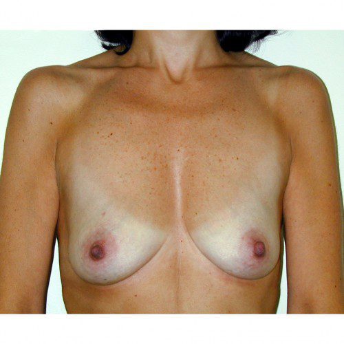 Breast Augmentation 18 Before Photo 