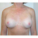 Breast Augmentation 19 After Photo - 8