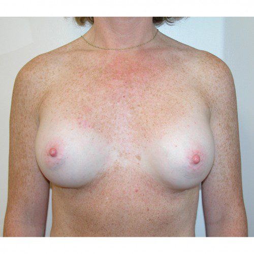 Breast Augmentation 19 After Photo 