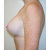 Breast Augmentation 19 After Photo Thumbnail