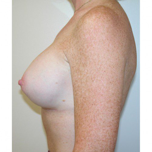 Breast Augmentation 19 After Photo