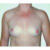 Breast Augmentation 19 Before Photo Thumbnail