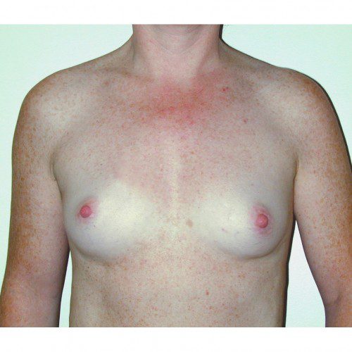 Breast Augmentation 19 Before Photo 