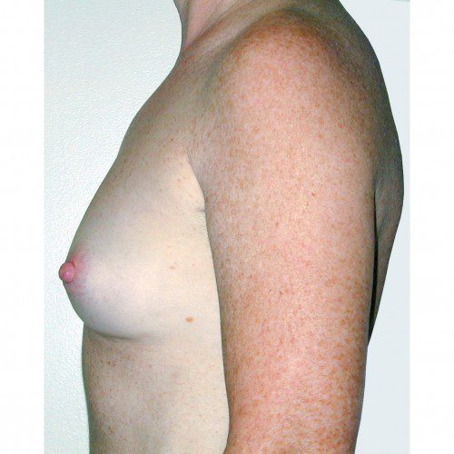 Breast Augmentation 19 Before Photo