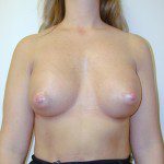 Breast Augmentation 21 After Photo - 6