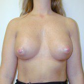 Breast Augmentation 21