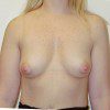 Breast Augmentation 21 Before Photo Thumbnail