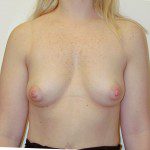 Breast Augmentation 21 Before Photo - 9