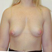 Breast Augmentation 21