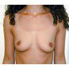 Breast Augmentation 22 Before Photo Thumbnail