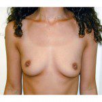 Breast Augmentation 22 Before Photo - 8