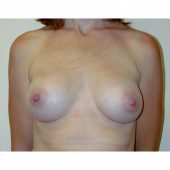 Breast Augmentation 23