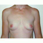 Breast Augmentation 23 Before Photo - 4