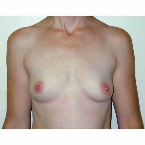 Breast Augmentation 23 Before Photo 