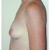 Breast Augmentation 23 Before Photo Thumbnail