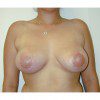 Breast Augmentation 24 After Photo Thumbnail