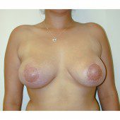 Breast Augmentation 24