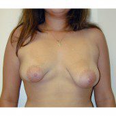 Breast Augmentation 24