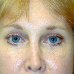 Blepharoplasty 1 After Photo - 9