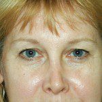 Blepharoplasty 1 Before Photo - 9