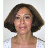 California Facelift 322