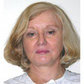 California Facelift 57