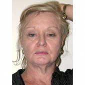 California Facelift 57