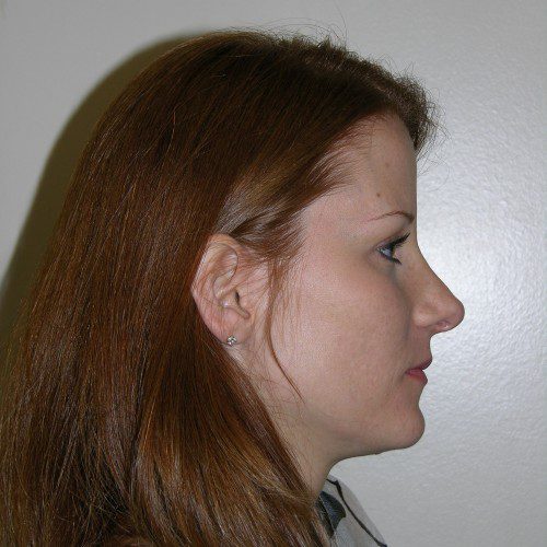 Rhinoplasty 0 After Photo 