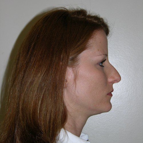 Rhinoplasty 0 Before Photo 