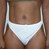 Abdominoplasty 3