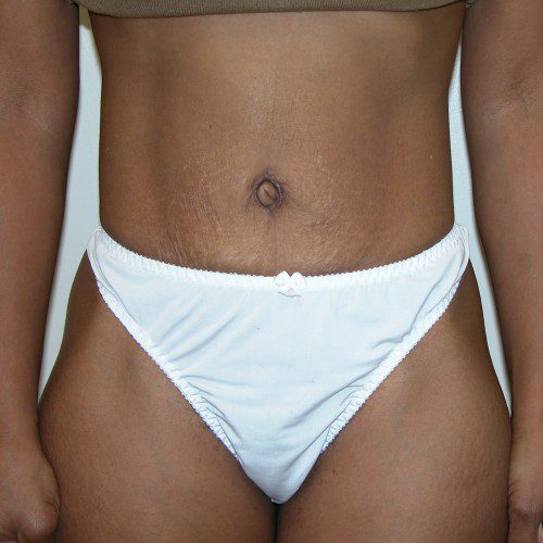 Abdominoplasty 3 After Photo 