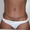 Abdominoplasty 3 After Photo Thumbnail