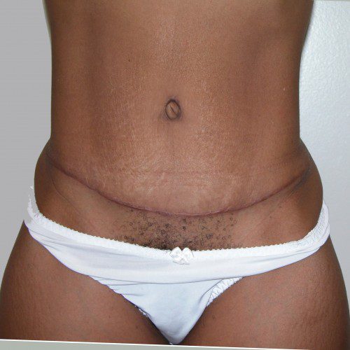 Abdominoplasty 3 After Photo