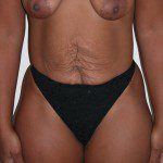 Abdominoplasty 3 Before Photo - 2