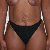 Abdominoplasty 3