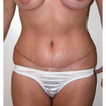 Abdominoplasty 2 After Photo - 3